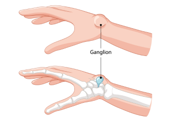 HOW TO TREAT VULVITIS WITH HOMEOPATHIC MEDICINES